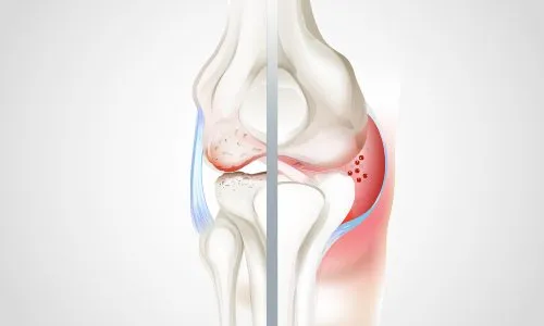 arthrite-arthrose